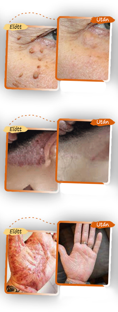 ✅ Pureluxo® Fekete Rizses Bőrregeneráló Krém 👨⚕️ (Szemölcsök, bőrkinövések, foltok és hiperpigmentáció kezelésére)🍀