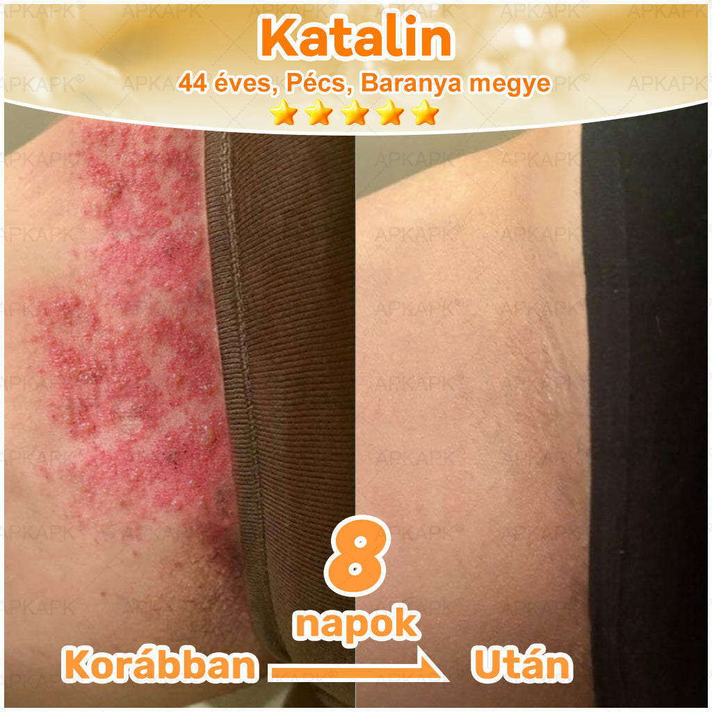 🎁🧡APKAPK®  Méhméreg krém a bőr megújítására 🐝 segít megoldani olyan bőrproblémákat, mint: ráncok, hegek, pigmentfoltok, striák, akné, pikkelysömör, ekcéma, bőrelváltozások, irritációk, gyulladások és egyéb bőrpanaszok.🧡🐝🐝