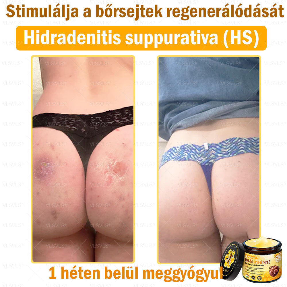 VLSVLS® Méhméreg Bőrhelyreállító Krém (👨‍⚕‍CE jóváhagyott)👍✅✅