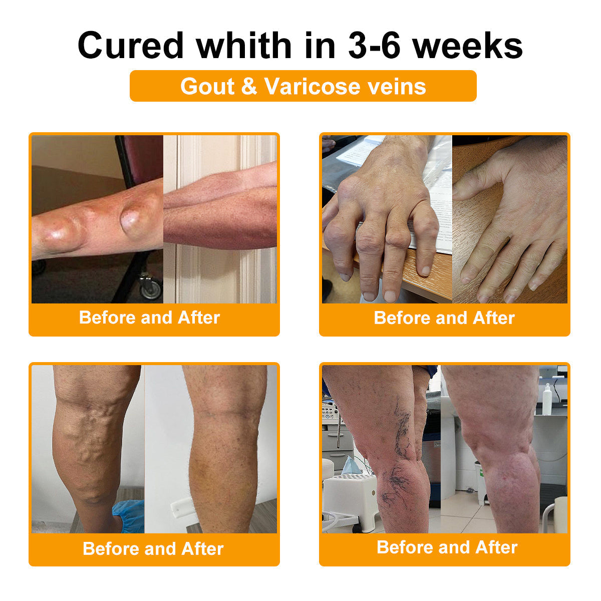 🦴TLOPA® Botulinum Toxin és Méhméreg Fájdalomcsillapító Csontgyógyító Krém🐝 🔥(Kifejezetten időseknek & ortopéd szakorvosok ajánlásával)🦴🦴