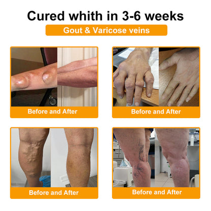 🦴TLOPA® Botulinum Toxin és Méhméreg Fájdalomcsillapító Csontgyógyító Krém🐝 🔥(Kifejezetten időseknek & ortopéd szakorvosok ajánlásával)🦴🦴