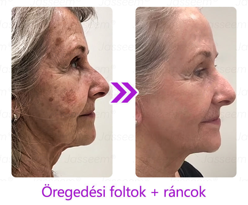 𝐉𝐚𝐬𝐬𝐞𝐞𝐦® Fejlett, nem invazív bőrjavító CO₂ lézeres toll 🛫 (Gyengéden eltávolítja a szemölcsöket, anyajegyeket, öregségi foltokat és bőrkinövéseket – fájdalom és gond nélkül!)🔥🔥