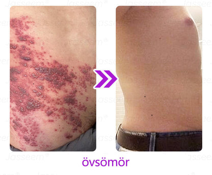 𝐉𝐚𝐬𝐬𝐞𝐞𝐦® Fejlett, nem invazív bőrjavító CO₂ lézeres toll 🛫 (Gyengéden eltávolítja a szemölcsöket, anyajegyeket, öregségi foltokat és bőrkinövéseket – fájdalom és gond nélkül!)🔥🔥