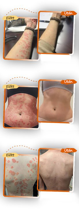 ✅ Pureluxo® Fekete Rizses Bőrregeneráló Krém 👨‍⚕️ (Szemölcsök, bőrkinövések, foltok és hiperpigmentáció kezelésére)✅✅✅