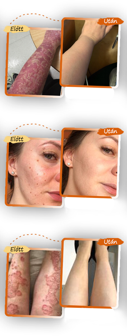 ✅ Pureluxo® Fekete Rizses Bőrregeneráló Krém 👨‍⚕️ (Szemölcsök, bőrkinövések, foltok és hiperpigmentáció kezelésére)✅✅✅