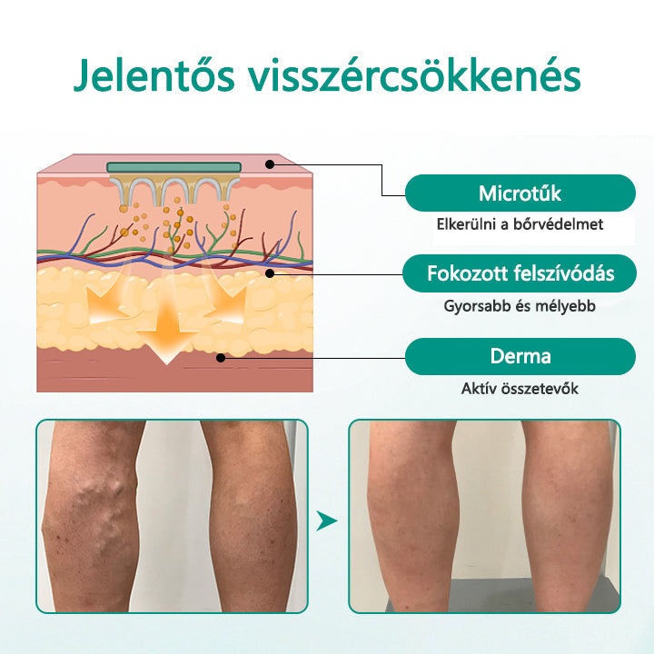 Cvreoz® LegRenew visszér tapasz javítja a vénák egészségét és megszünteti a visszereket🌿Nincs tű, nincs műtét, csak biztonságos, gyengéd és hatékony eredmény✨✨✨✨