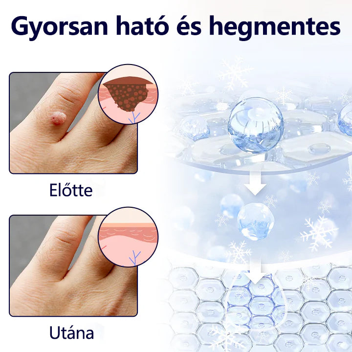 Timilk® WartErase – Fagyasztó Szemölcseltávolító Spray❄️❄️❄️
