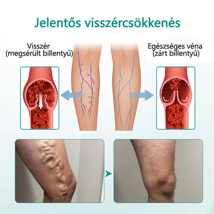 Cvreoz® LegRenew visszér tapasz javítja a vénák egészségét és megszünteti a visszereket🌿Nincs tű, nincs műtét, csak biztonságos, gyengéd és hatékony eredmény✨✨✨✨