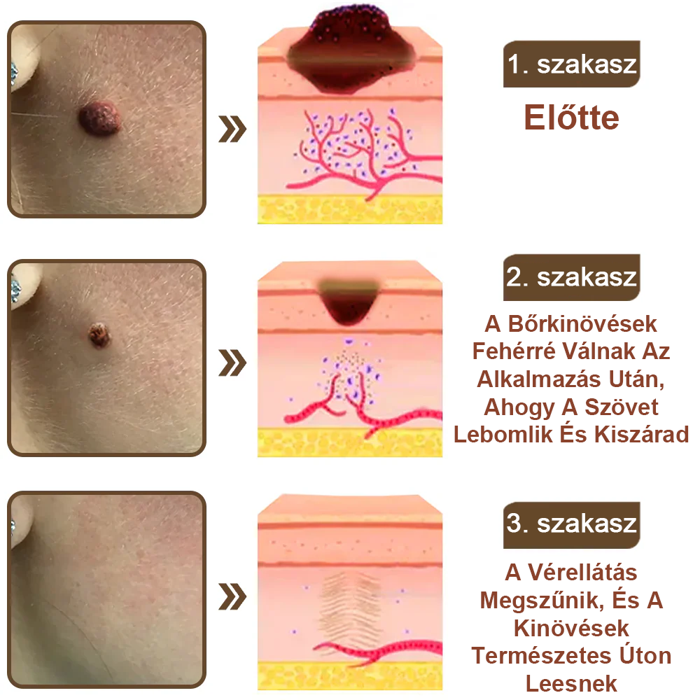 ✅ Pureluxo® Fekete Rizses Bőrregeneráló Krém 👨‍⚕️ (Szemölcsök, bőrkinövések, foltok és hiperpigmentáció kezelésére)✅✅✅