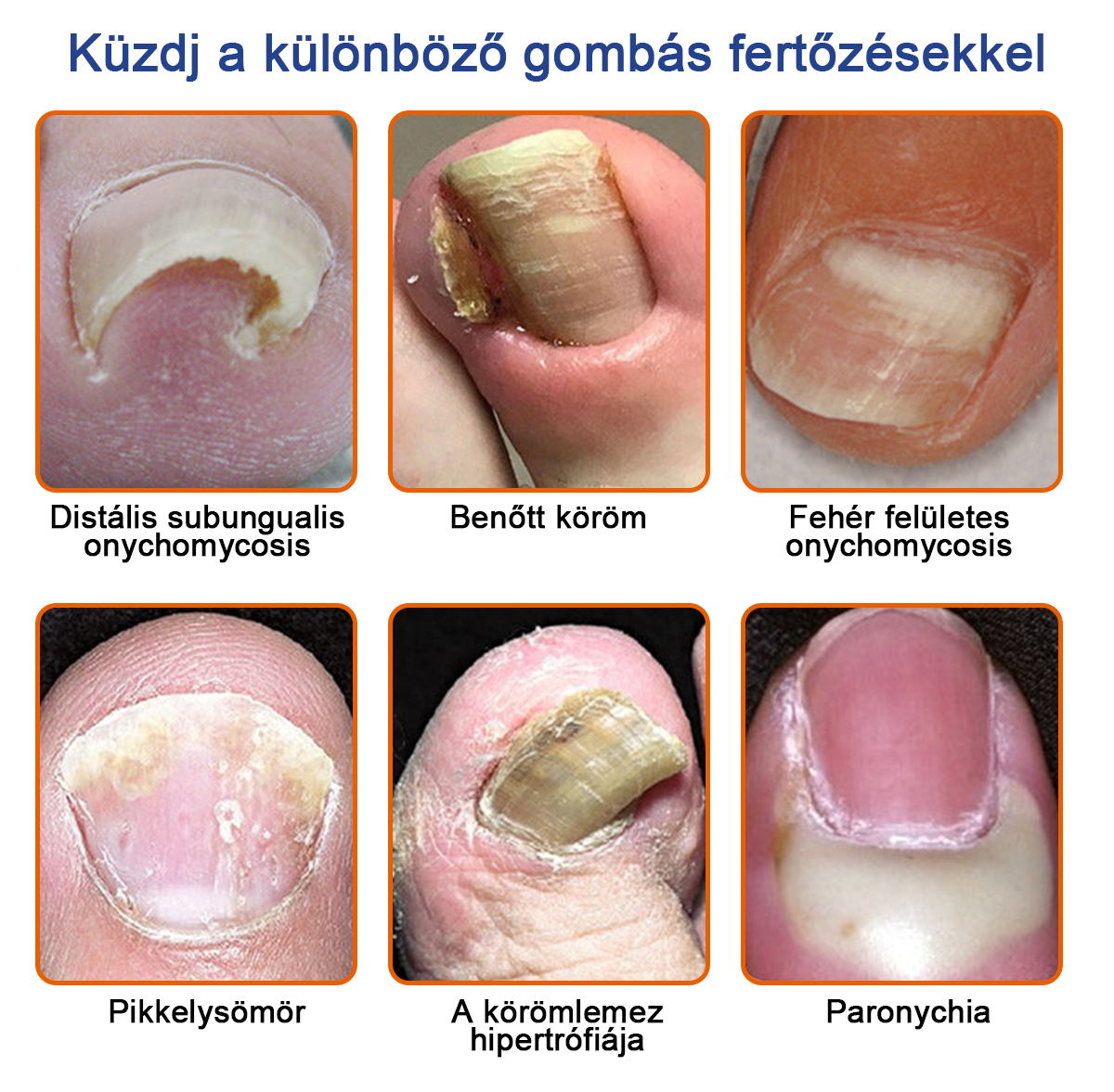 👣🐝🐝Furzero™ Méhméreg Körömgomba Kezelőoldat: Teljes megoldás a körömgomba problémájára🌟👣👣