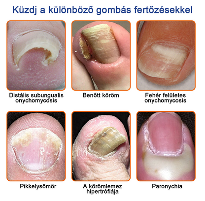 👣🐝🐝Furzero™ Méhméreg Körömgomba Kezelőoldat: Teljes megoldás a körömgomba problémájára🌟👣👣