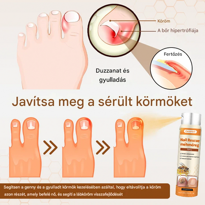 💥 2025 Korlátozott 70% KEDVEZMÉNY ️⏳ Ceoerty® NailRescue Kolirin méhméreg körömgomba spray 💥 Minden körömproblémát orvosolhatsz 2 héten belül👣