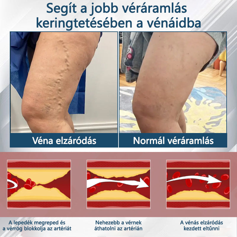 Cvreoz® Fekete kömény Ödéma méregtelenítő gyógynövénykrém - a gyors, látható enyhülés érdekében🍃